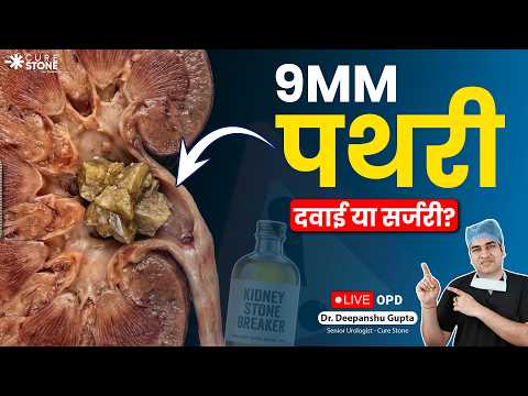 9mm Kidney Stone Treatment | क्या 9mm की पथरी दवाई से निकलेगी? | Cure Stone