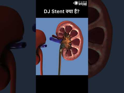 What is DJ stent and how it is removed #urology