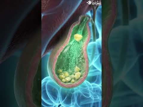 How gall bladder stones are formed