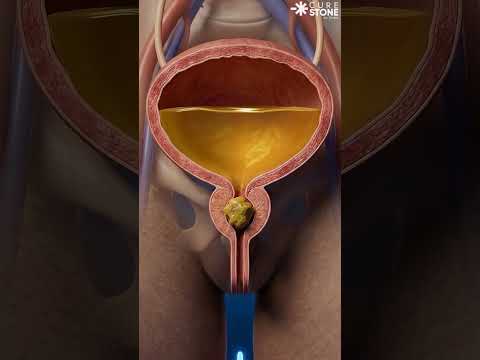 How urethral stones are removed #urology