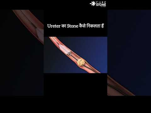 How ureteric stones are removed #urology