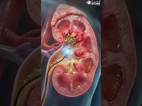 10mm upper pole KIDNEY stones treatment #urology