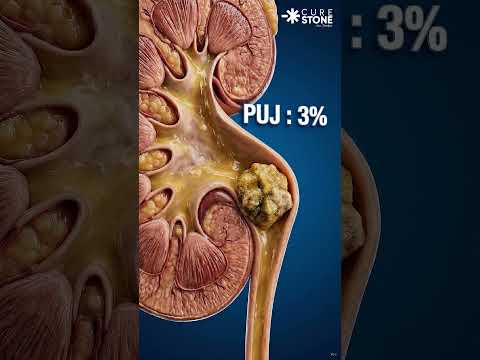Will 12mm kidney stone get removed spontaneously #urology
