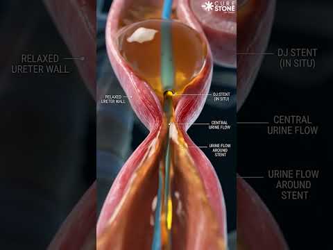 What is DJ stent and how it is removed #urology