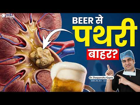 क्या Beer से पथरी निकलती है? | Truth About Kidney Stones by Dr. Deepanshu Gupta