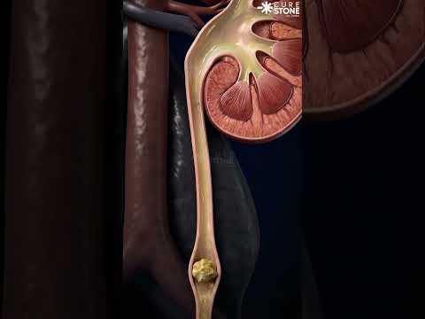 What are the chances that a 6mm kidney stone will pass