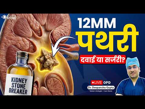 12mm Kidney Stone Treatment: Can Medicine Cure It? | 12mm पथरी का इलाज | Live OPD | Dr. Deepanshu
