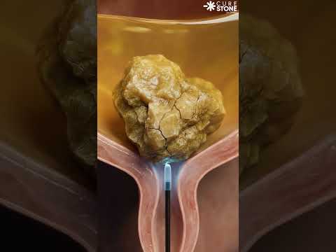 How urinary Bladder stones are removed #urology