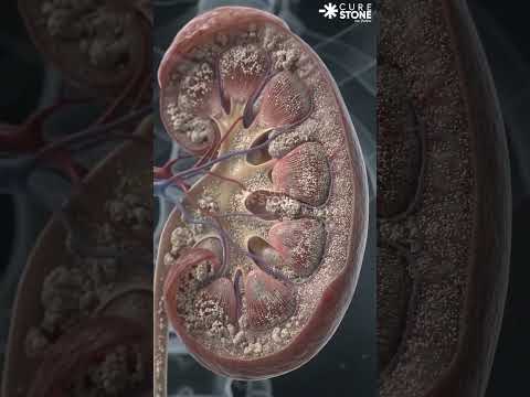 What is nephrocalcinosis #urology #curestone