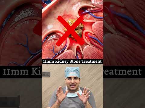 11 mm kidney stones treatment #urology