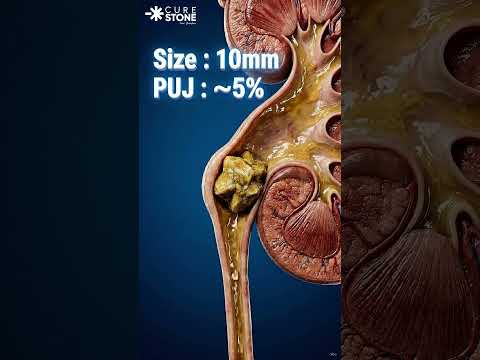 What are the chances of removal of kidney stone #urology