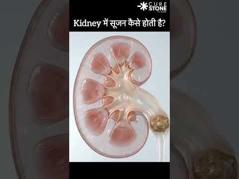 How hydronephrosis develops in kidney #urology