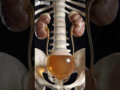 How bladder distends when urine is collecting into it #urology