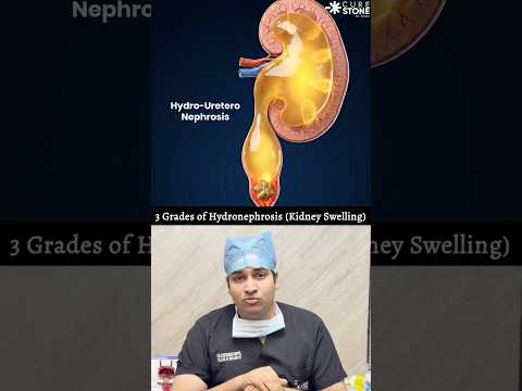 What is hydronephrosis #urology
