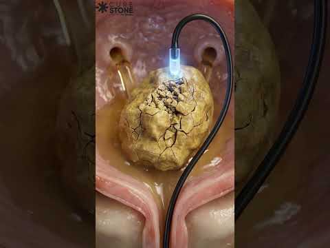 How bladder stones are removed #urology