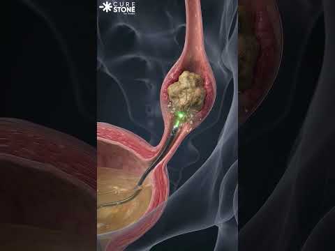 How VUJ stones are treated #urology