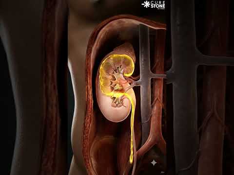 Kidney stones were found in mummy body #urology