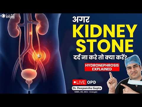 अगर Kidney Stone दर्द ना करे तो क्या करें? | Silent Stones Treatment & Hydronephrosis | Cure Stone