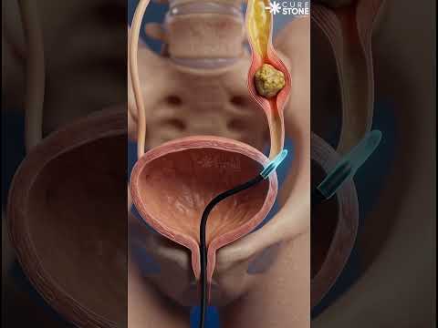 How lower ureteric stones are removed #urology