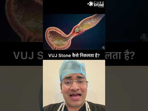 How VUJ stones are removed #urology