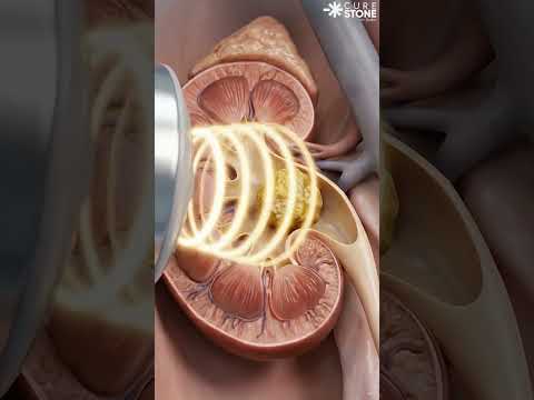 What is ESWL | How sound waves breaks stones #urology