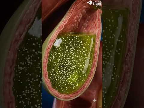 What are Gall Stones and how are they formed?
