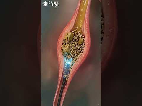 Animation showing kidney mid ureteric stone treatment #urology