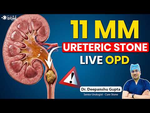 पथरी बार-बार क्यों बनती है? Genetics? | Moderate Hydro-nephrosis explained | Dr. Deepanshu Gupta