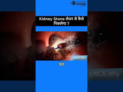 Kidney stones treatment | Rirs Animation | How kidney stones are removed #kidneystones