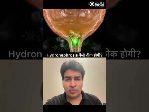 Treatment of hydronephrosis due to stone #urology