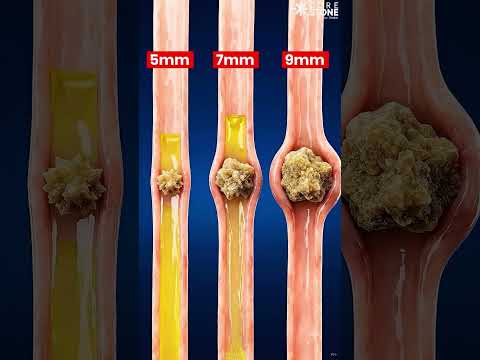 How my stone can come out of kidney #urology