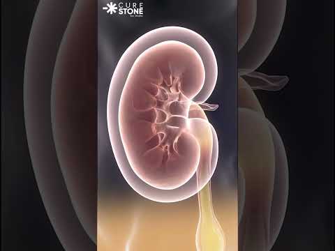Why kidney stone casues so much pain #urology