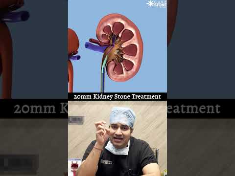 20 mm kidney stone treatment #urology