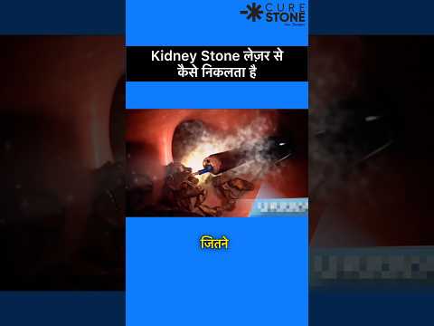 rirs animation | rirs treatment for kidney stones | How rirs is done  kidney stones treatment#shorts