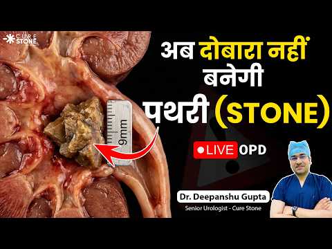 Kidney Stone बार-बार क्यों होता है? Recurrent Kidney Stones Causes & Treatment | Cure Stone