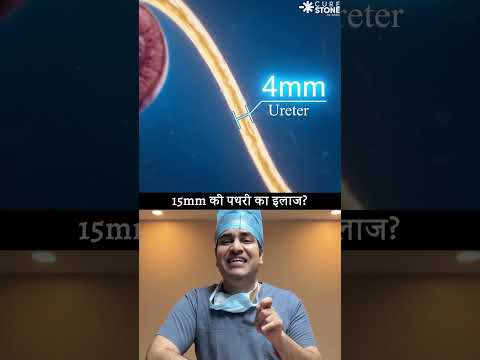 How 15 mm kidney stones are treated #urology