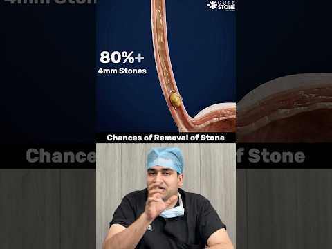 What are the chances that your kidney stone will remove #kidneystones
