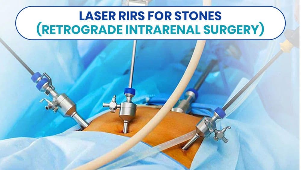 Laser RIRS for Stones (Retrograde Intrarenal Surgery)
