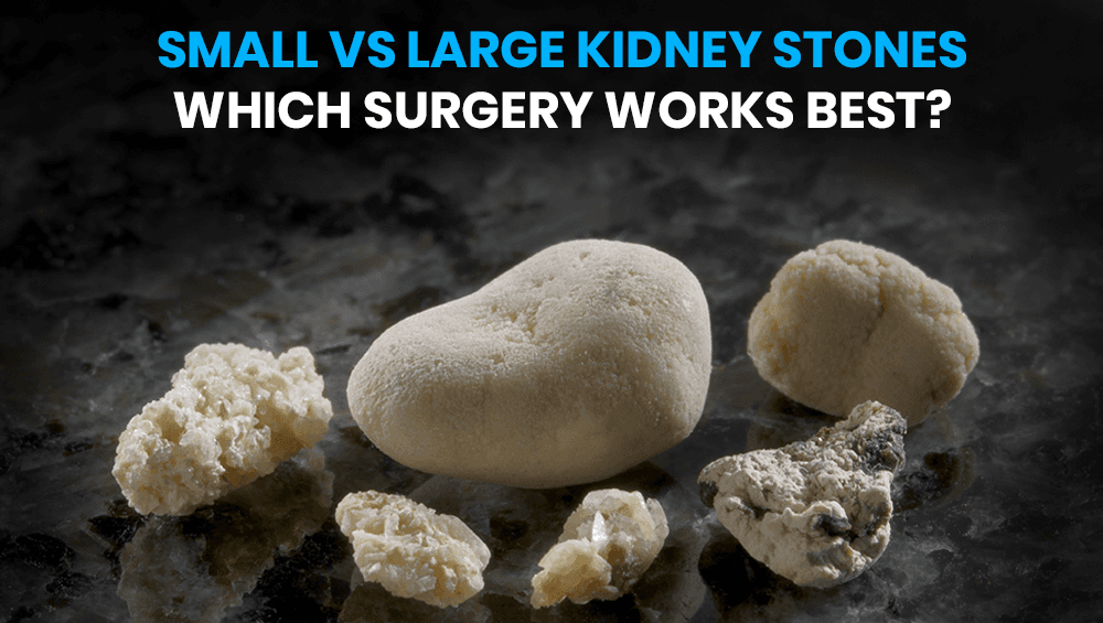 Small vs large kidney stones – Which surgery works best?