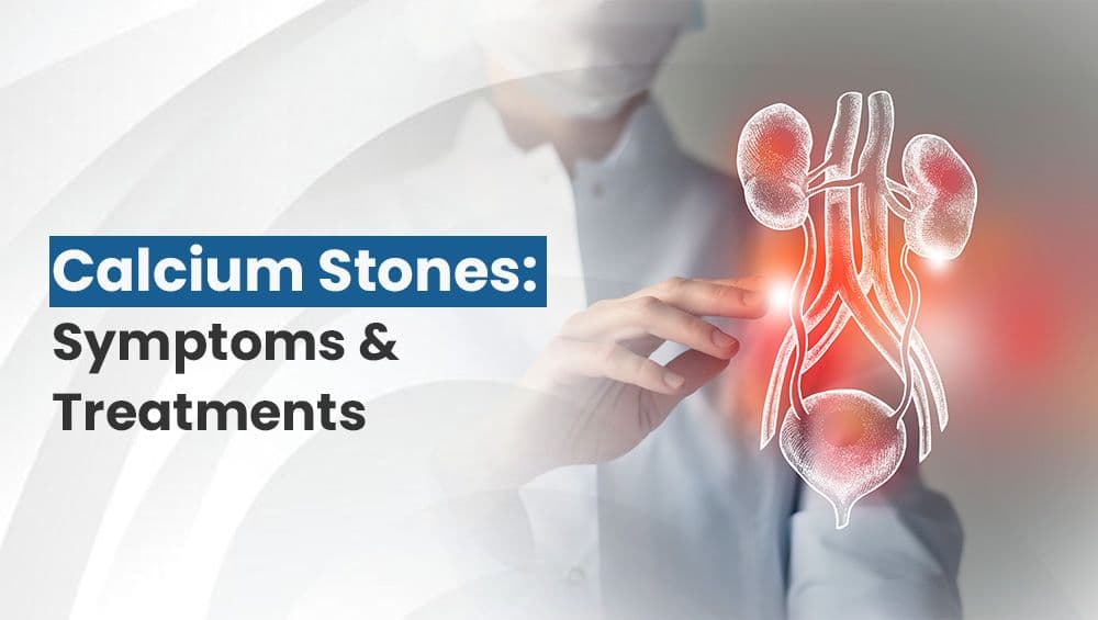 Calcium Stones: Symptoms & Treatments
