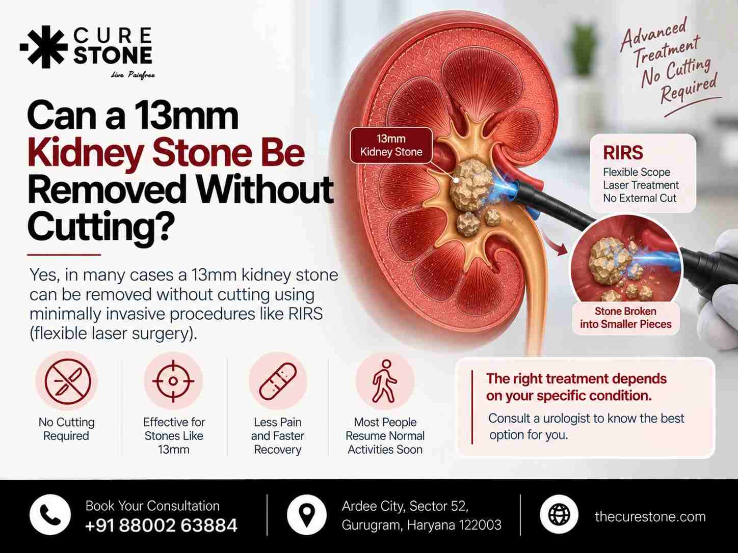 Can a 13mm Kidney Stone Be Removed Without Cutting?