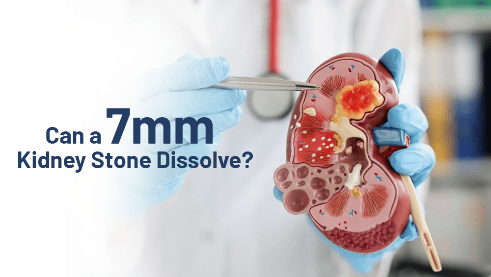 Can a 7mm Kidney Stone Dissolve?
