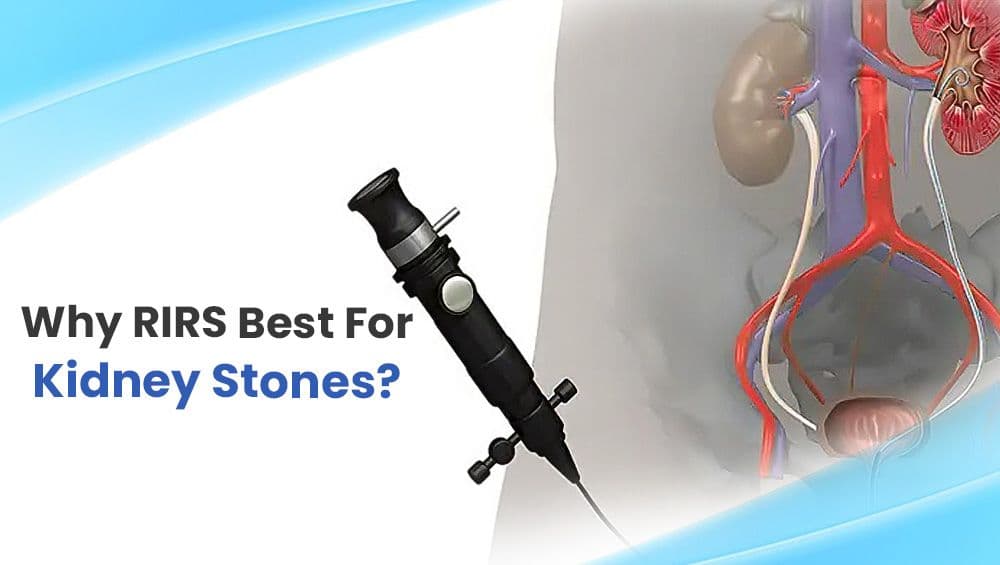 Why RIRS Best For Kidney Stones?