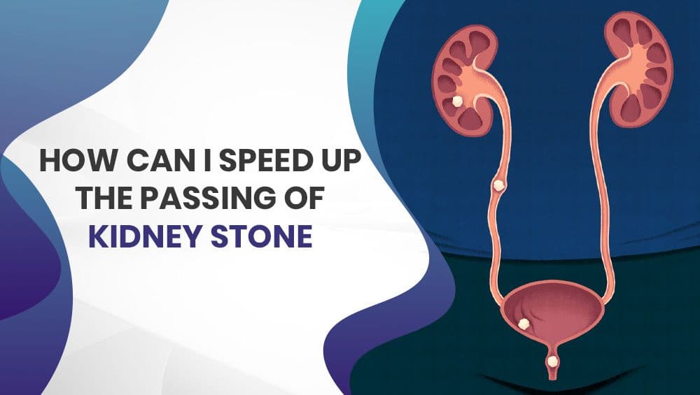 How can I speed up the passing of kidney stones?