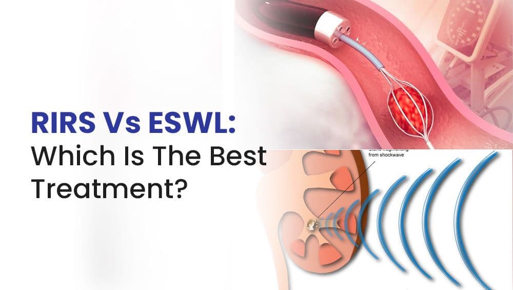 RIRS Vs ESWL: Which Is The Best Treatment?