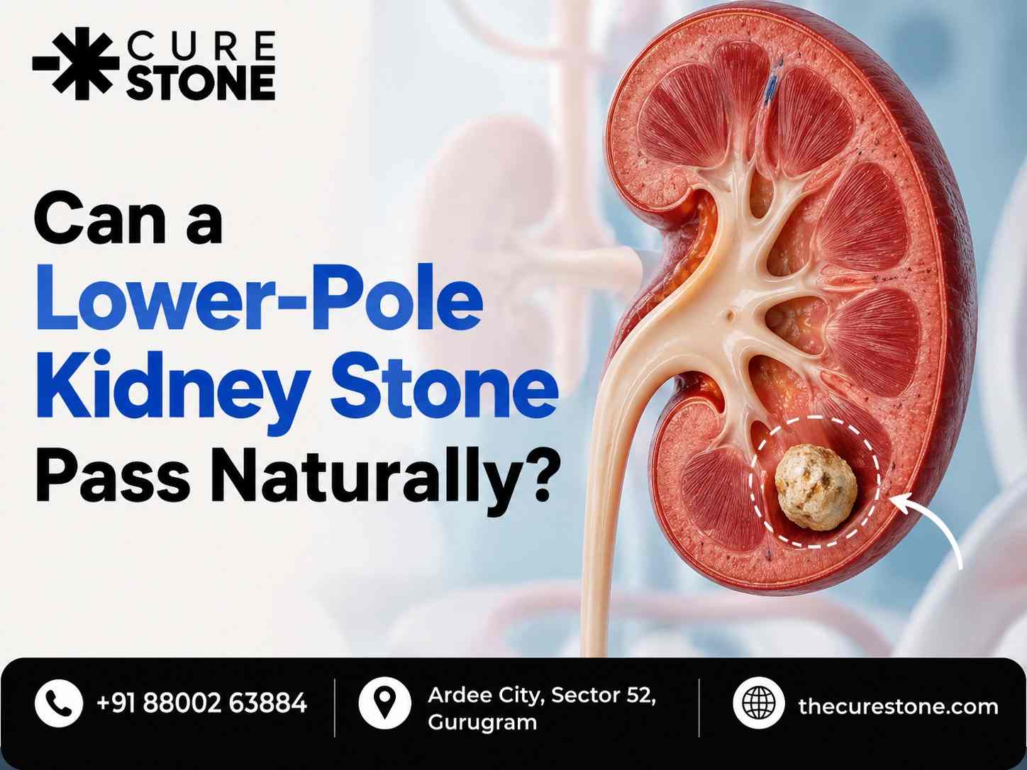 Can a Lower Pole Kidney Stone Pass Naturally?