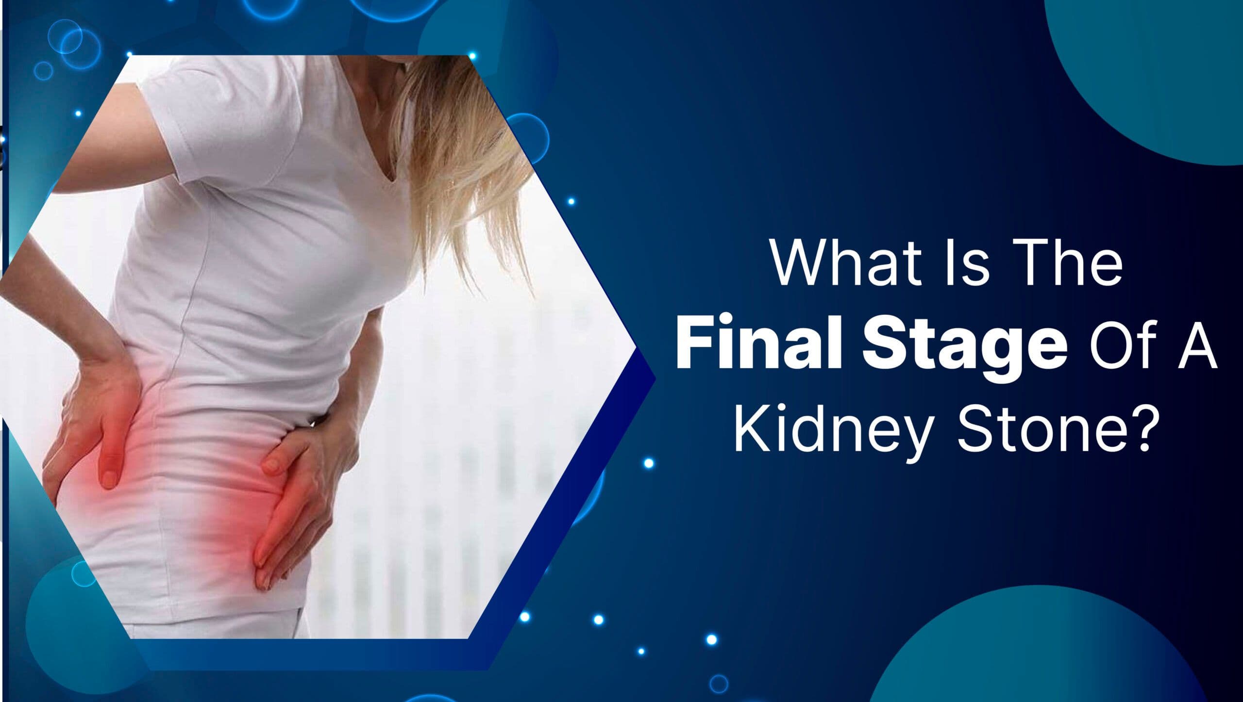 What Is The Final Stage Of A Kidney Stone?