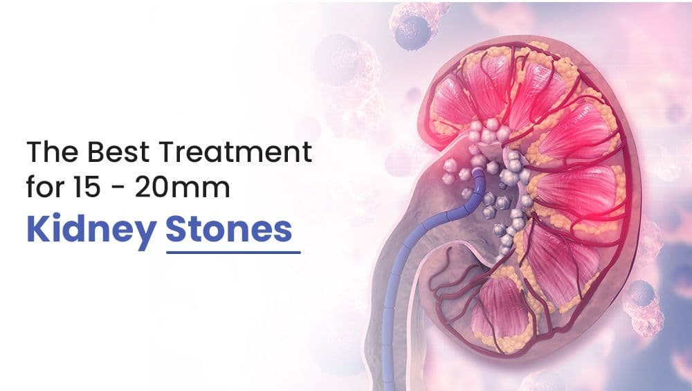 The Best Treatment for 15 – 20mm Kidney Stones