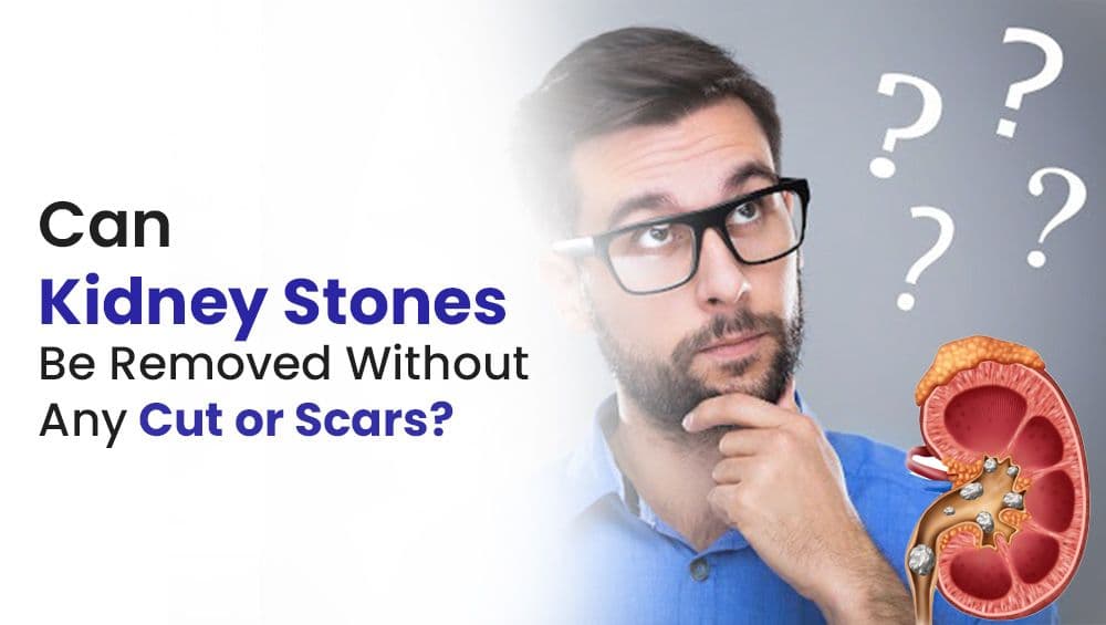 Can Kidney Stones Be Removed Without Any Cut or Scars?