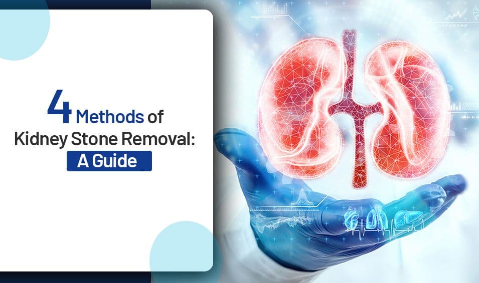 4 Methods of Kidney Stone Removal: A Guide